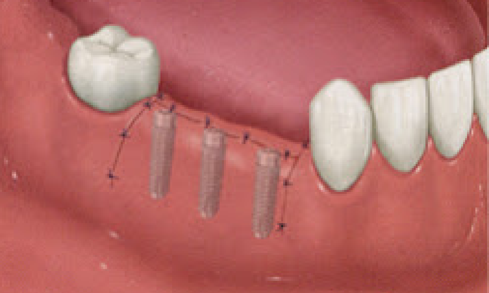 3.人工歯根を埋め込む